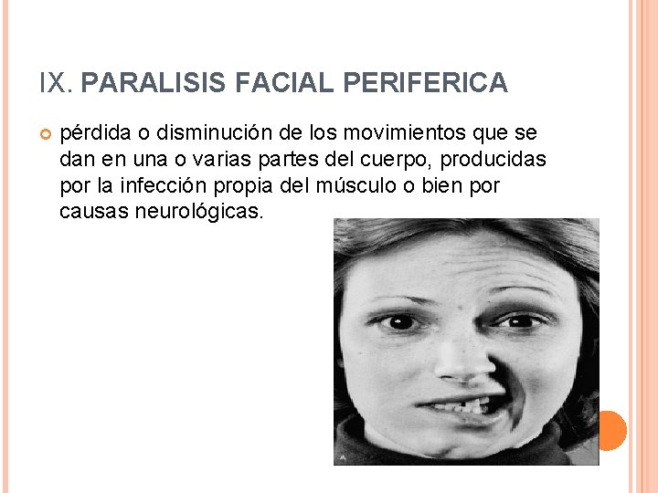 IX. PARALISIS FACIAL PERIFERICA pérdida o disminución de los movimientos que se dan en