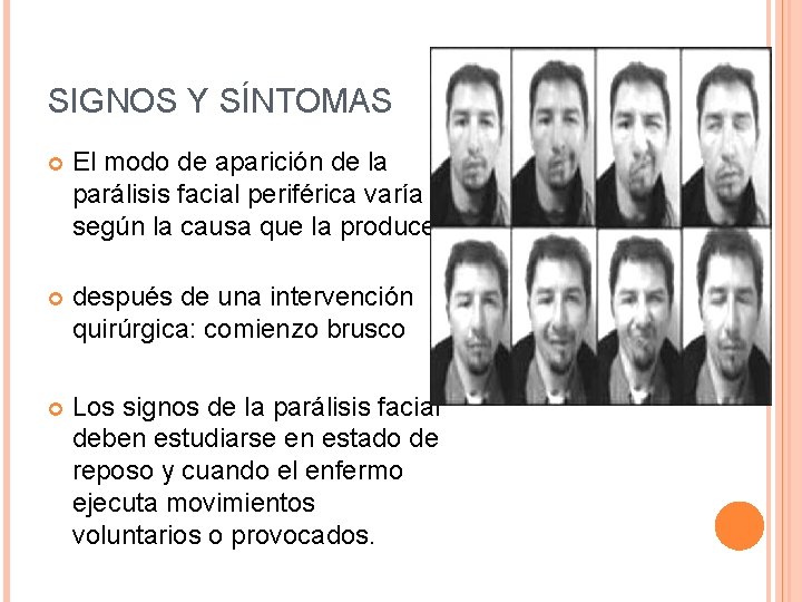 SIGNOS Y SÍNTOMAS El modo de aparición de la parálisis facial periférica varía según