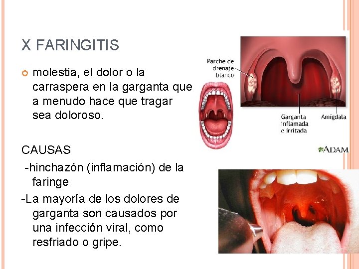 X FARINGITIS molestia, el dolor o la carraspera en la garganta que a menudo