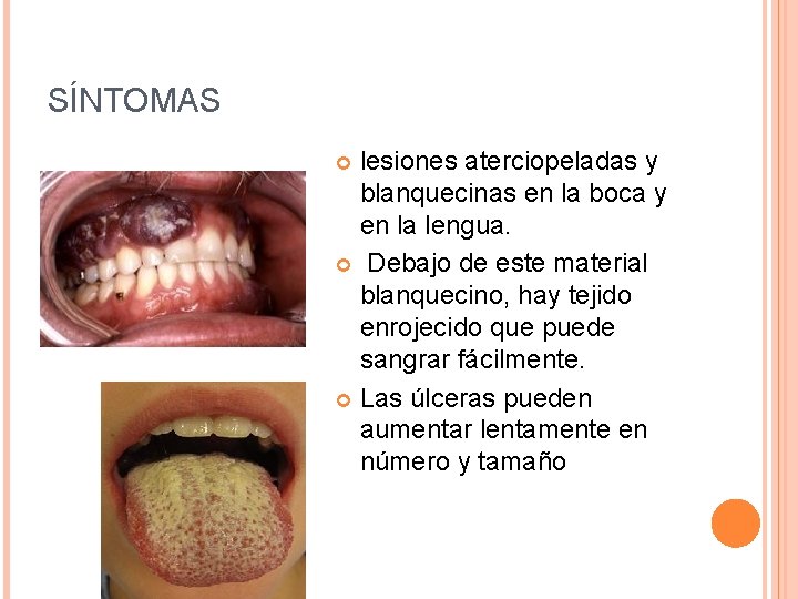 SÍNTOMAS lesiones aterciopeladas y blanquecinas en la boca y en la lengua. Debajo de