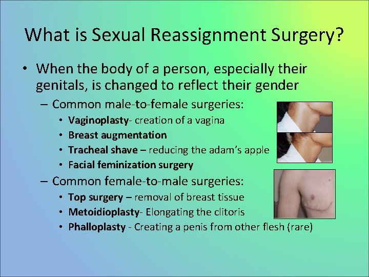 What is Sexual Reassignment Surgery? • When the body of a person, especially their