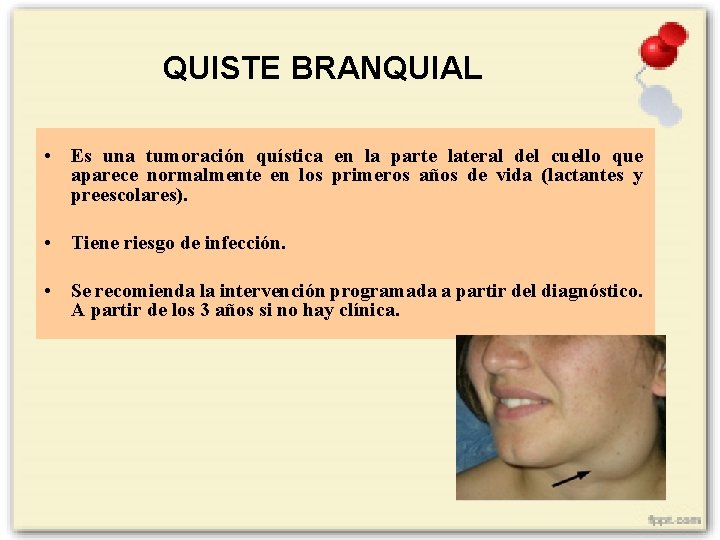 QUISTE BRANQUIAL • Es una tumoración quística en la parte lateral del cuello que