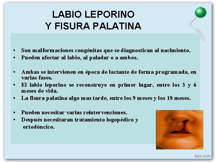 LABIO LEPORINO Y FISURA PALATINA • Son malformaciones congénitas que se diagnostican al nacimiento.