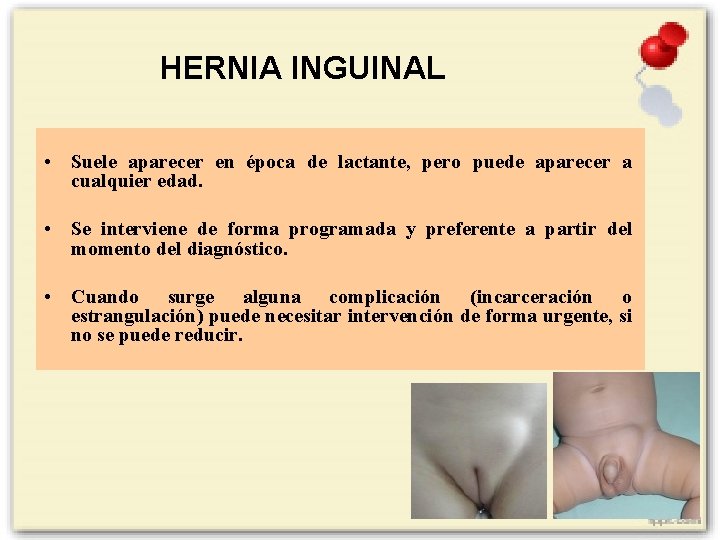 HERNIA INGUINAL • Suele aparecer en época de lactante, pero puede aparecer a cualquier