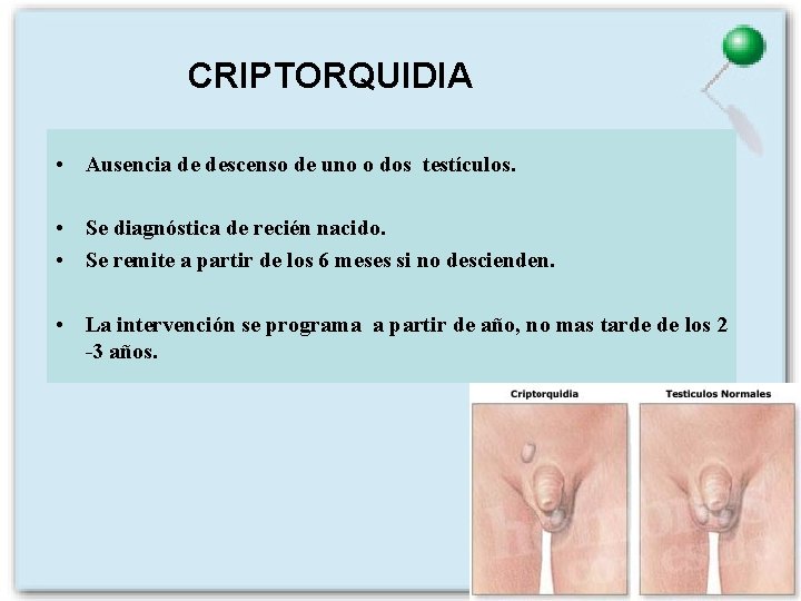 CRIPTORQUIDIA • Ausencia de descenso de uno o dos testículos. • Se diagnóstica de