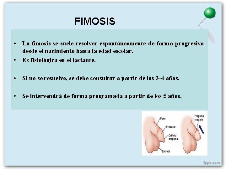 FIMOSIS • La fimosis se suele resolver espontáneamente de forma progresiva desde el nacimiento