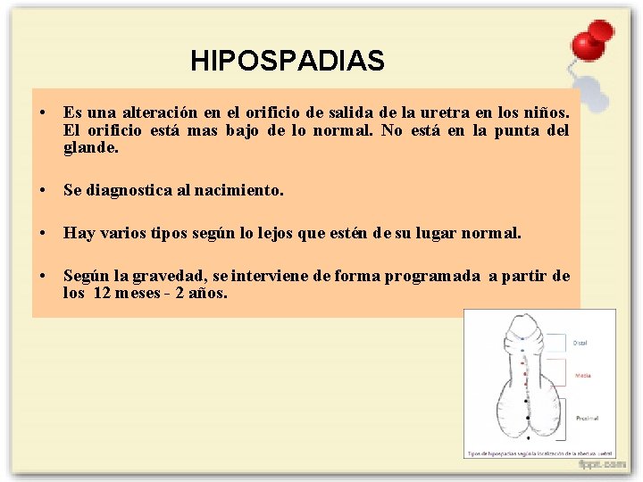 HIPOSPADIAS • Es una alteración en el orificio de salida de la uretra en