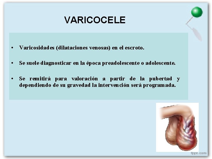 VARICOCELE • Varicosidades (dilataciones venosas) en el escroto. • Se suele diagnosticar en la