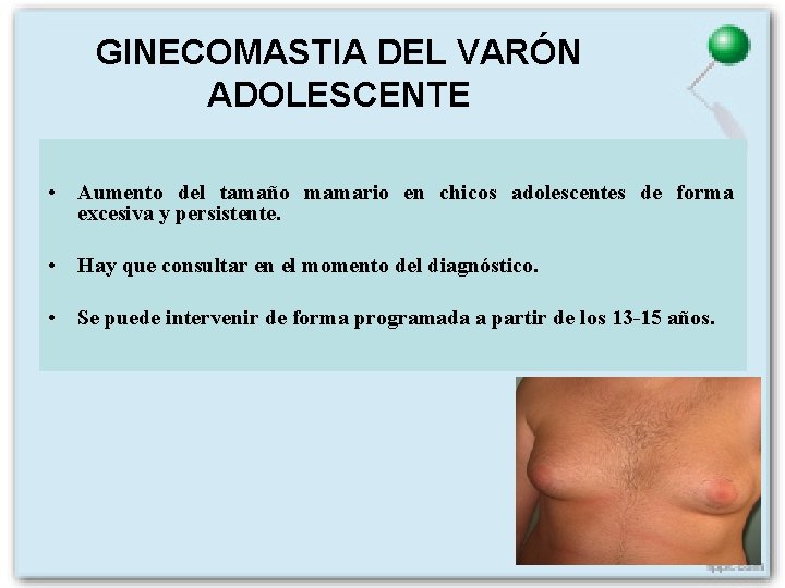 GINECOMASTIA DEL VARÓN ADOLESCENTE • Aumento del tamaño mamario en chicos adolescentes de forma