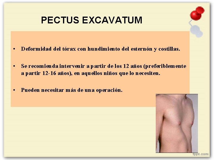 PECTUS EXCAVATUM • Deformidad del tórax con hundimiento del esternón y costillas. • Se