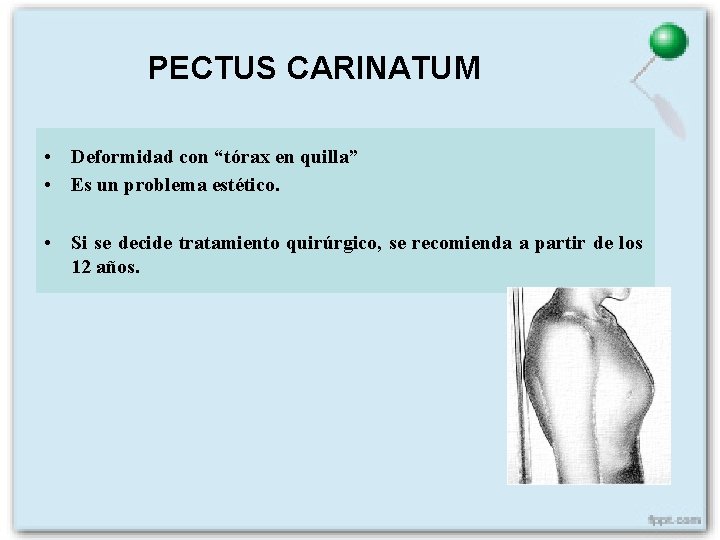 PECTUS CARINATUM • Deformidad con “tórax en quilla” • Es un problema estético. •