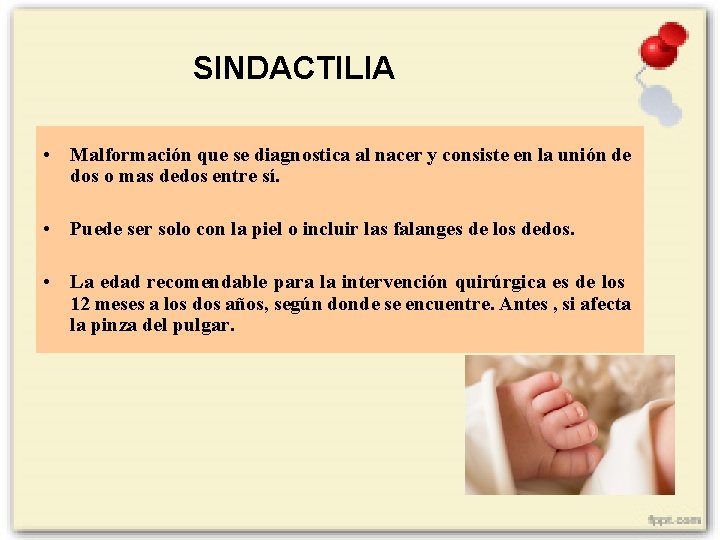 SINDACTILIA • Malformación que se diagnostica al nacer y consiste en la unión de