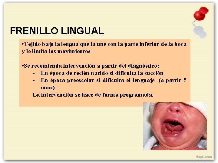 FRENILLO LINGUAL • Tejido bajo la lengua que la une con la parte inferior