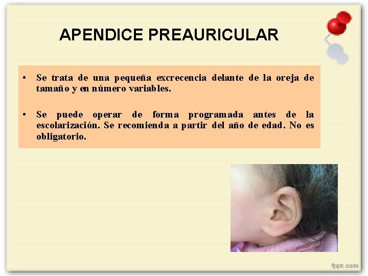 APENDICE PREAURICULAR • Se trata de una pequeña excrecencia delante de la oreja de