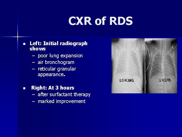 Cxr In Rds Respiratory Distress Syndrome or Hyaline Membrane Disease Dr