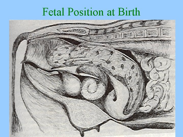 Fetal Position at Birth 