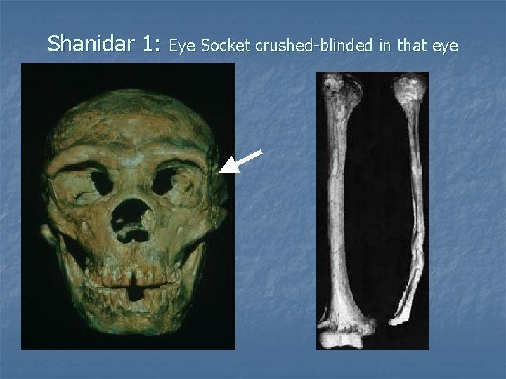 Shanidar 1: Eye Socket crushed-blinded in that eye 