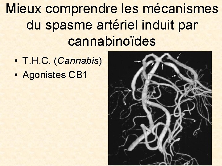 Mieux comprendre les mécanismes du spasme artériel induit par cannabinoïdes • T. H. C.