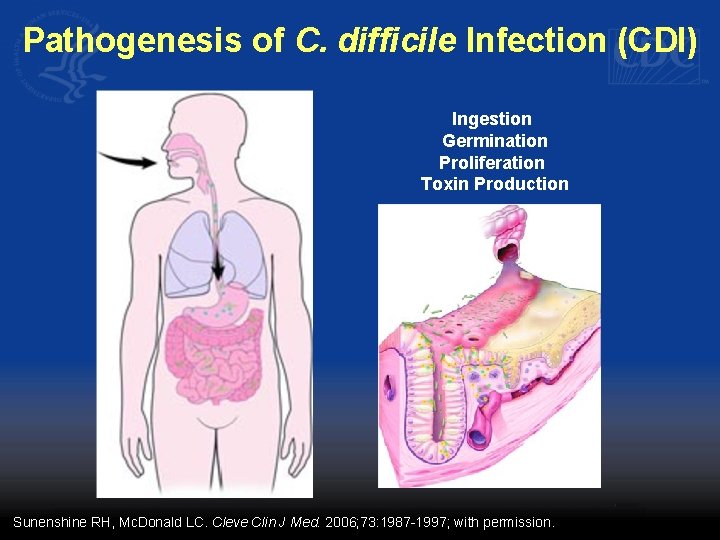 Pathogenesis of C. difficile Infection (CDI) Ingestion Germination Proliferation Toxin Production Sunenshine RH, Mc.