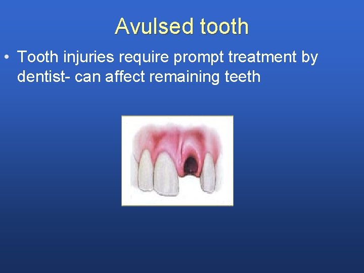Avulsed tooth • Tooth injuries require prompt treatment by dentist- can affect remaining teeth