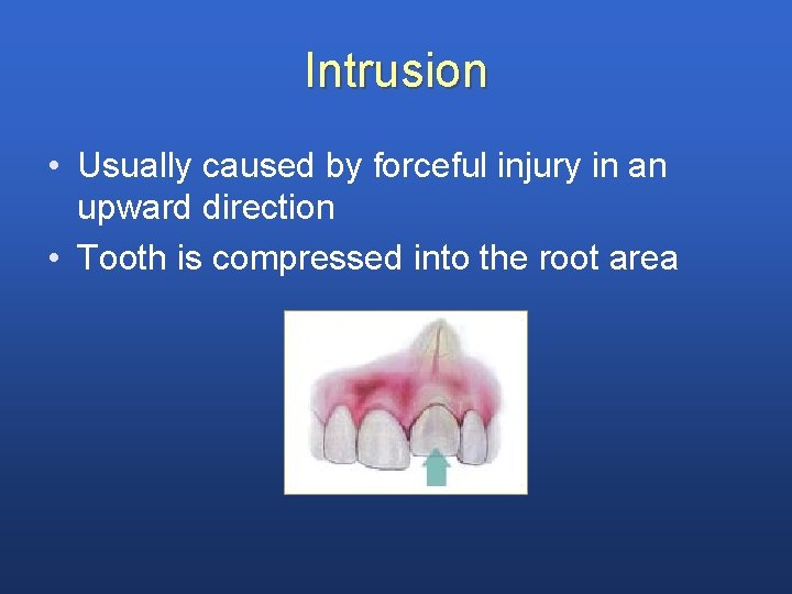 Intrusion • Usually caused by forceful injury in an upward direction • Tooth is