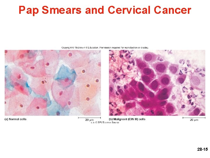 Pap Smears and Cervical Cancer Figure 28. 5 a, b 28 -15 