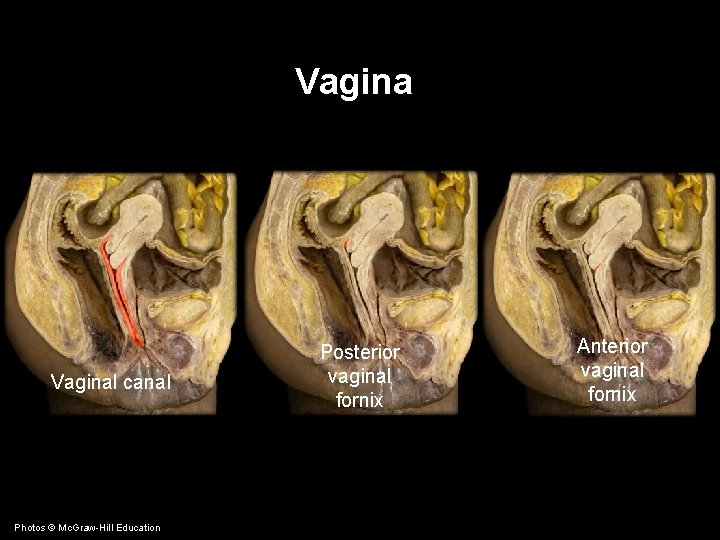 Vaginal canal Photos © Mc. Graw-Hill Education Posterior vaginal fornix Anterior vaginal fornix 