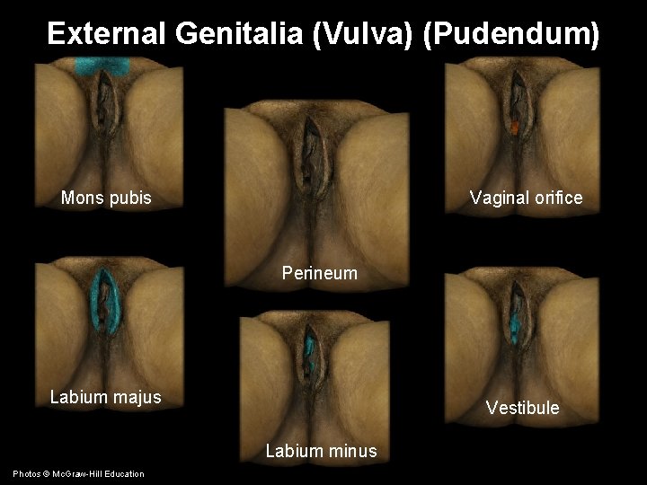 External Genitalia (Vulva) (Pudendum) Mons pubis Vaginal orifice Perineum Labium majus Vestibule Labium minus