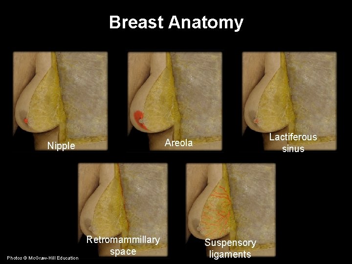 Breast Anatomy Nipple Photos © Mc. Graw-Hill Education Lactiferous sinus Areola Retromammillary space Suspensory