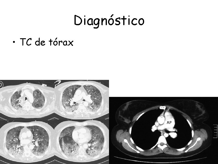 Diagnóstico • TC de tórax 