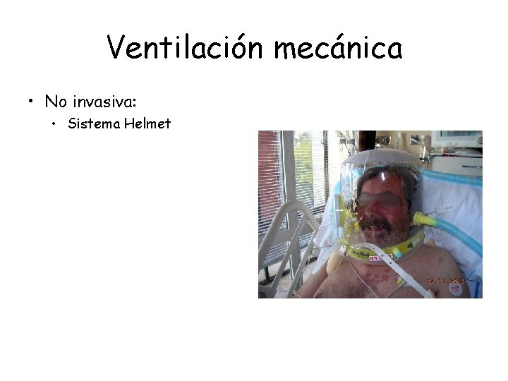 Ventilación mecánica • No invasiva: • Sistema Helmet 