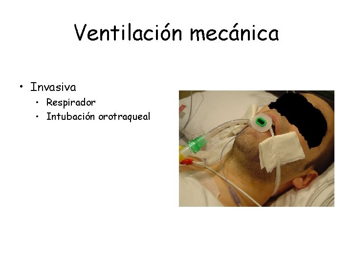 Ventilación mecánica • Invasiva • Respirador • Intubación orotraqueal 