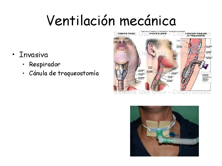 Ventilación mecánica • Invasiva • Respirador • Cánula de traqueostomía 