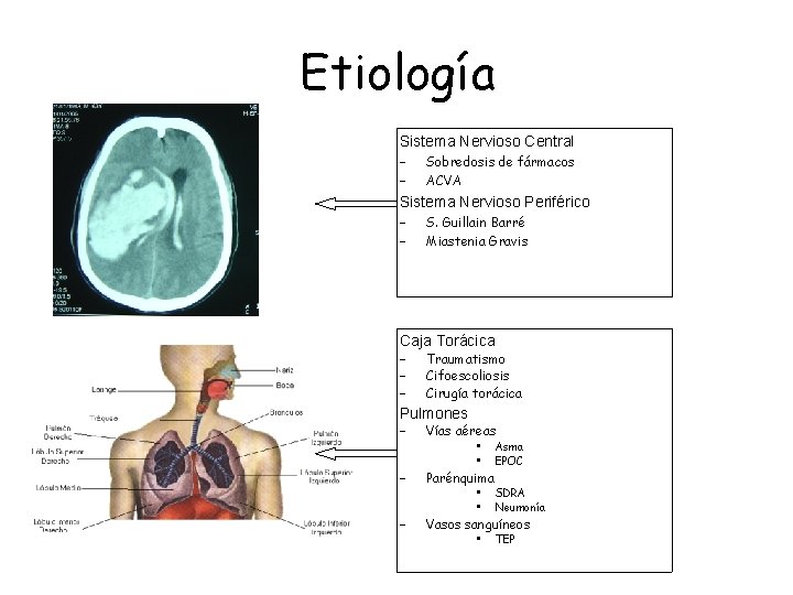 Etiología Sistema Nervioso Central – – Sobredosis de fármacos ACVA Sistema Nervioso Periférico –