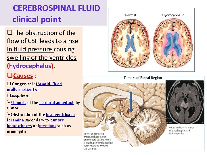 CEREBROSPINAL FLUID clinical point q. The obstruction of the flow of CSF leads to