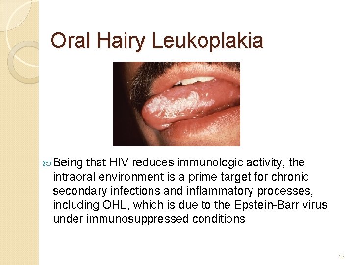 Oral Hairy Leukoplakia Being that HIV reduces immunologic activity, the intraoral environment is a