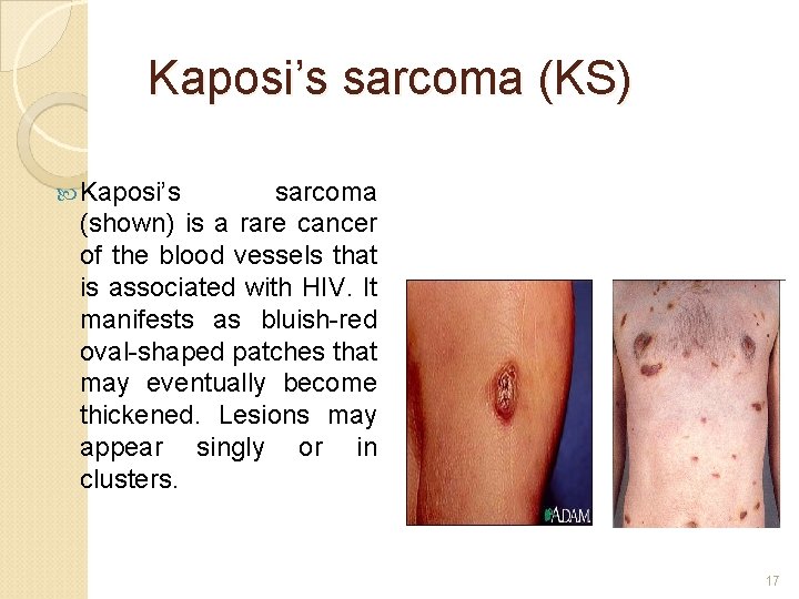 Kaposi’s sarcoma (KS) Kaposi’s sarcoma (shown) is a rare cancer of the blood vessels