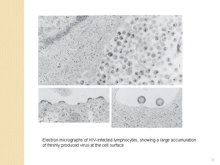 Electron micrographs of HIV-infected lymphocytes, showing a large accumulation of freshly produced virus at