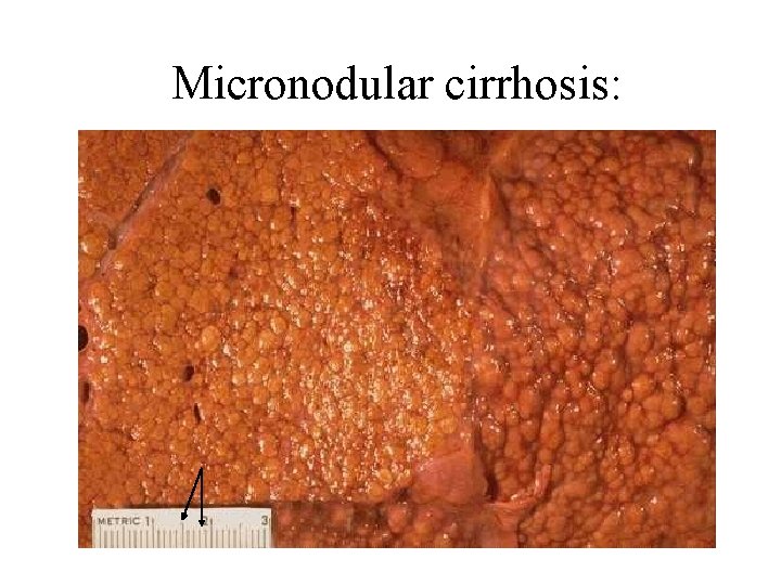 Micronodular cirrhosis: 