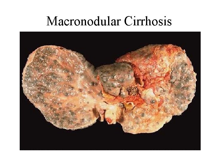 Macronodular Cirrhosis 