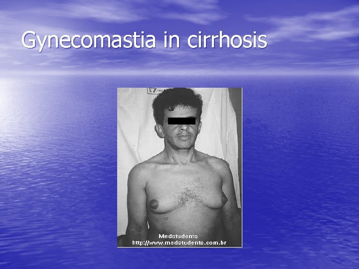 Gynecomastia in cirrhosis 