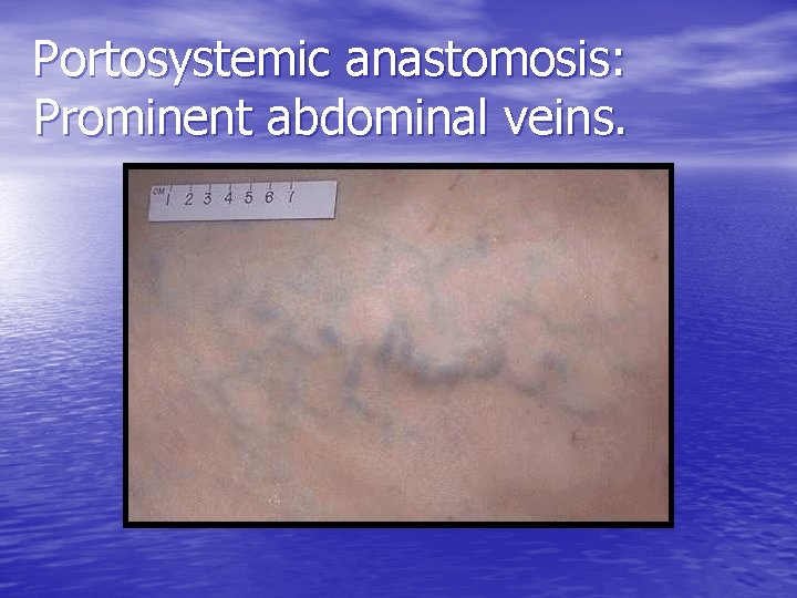 Portosystemic anastomosis: Prominent abdominal veins. 