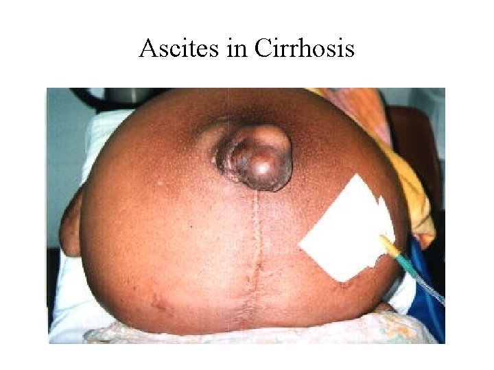 Ascites in Cirrhosis 