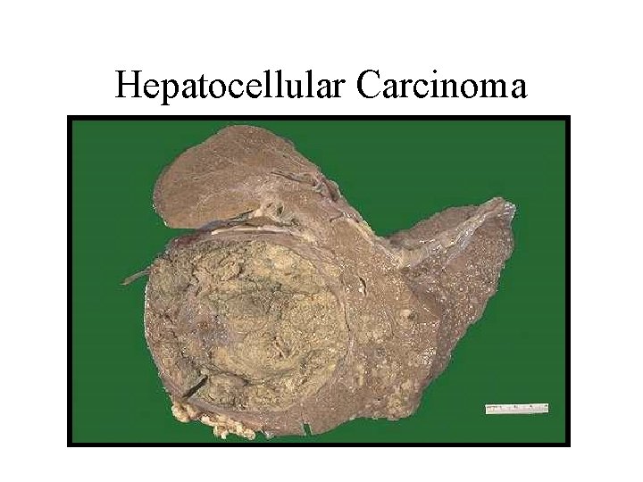 Hepatocellular Carcinoma 