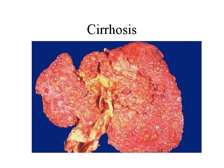 Cirrhosis 