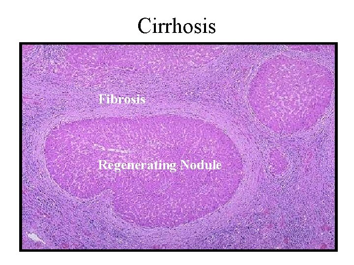 Cirrhosis Fibrosis Regenerating Nodule 