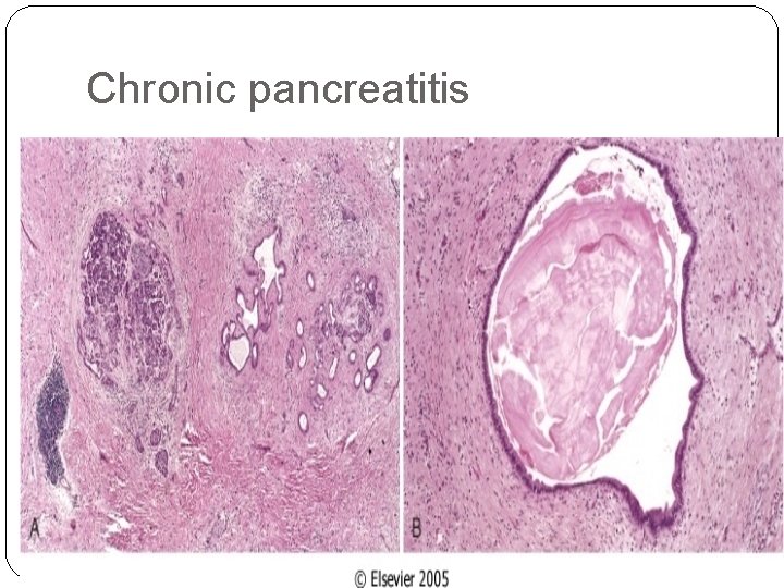 Chronic pancreatitis 