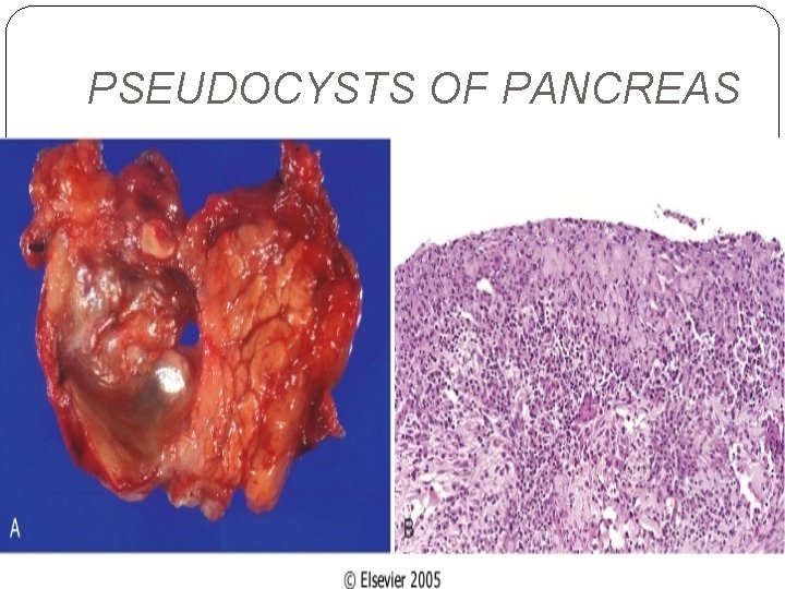 PSEUDOCYSTS OF PANCREAS 