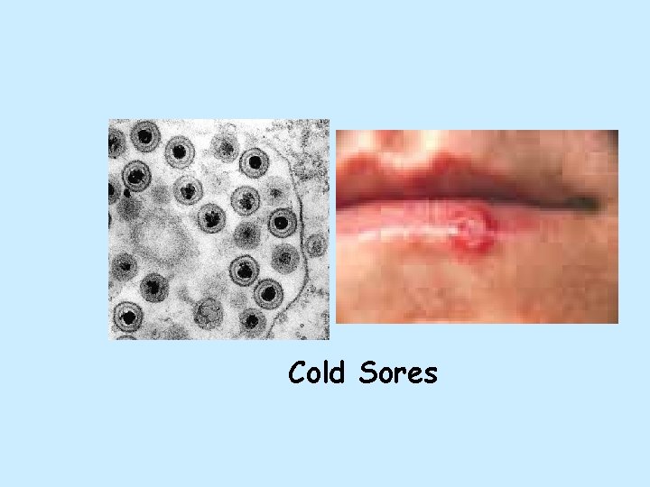 Cold Sores 