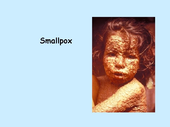 Smallpox 